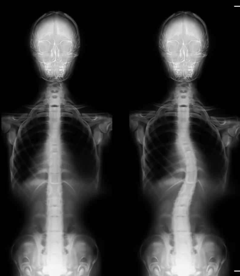 Scoliosis Washington